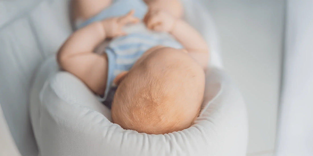 What is cradle cap?