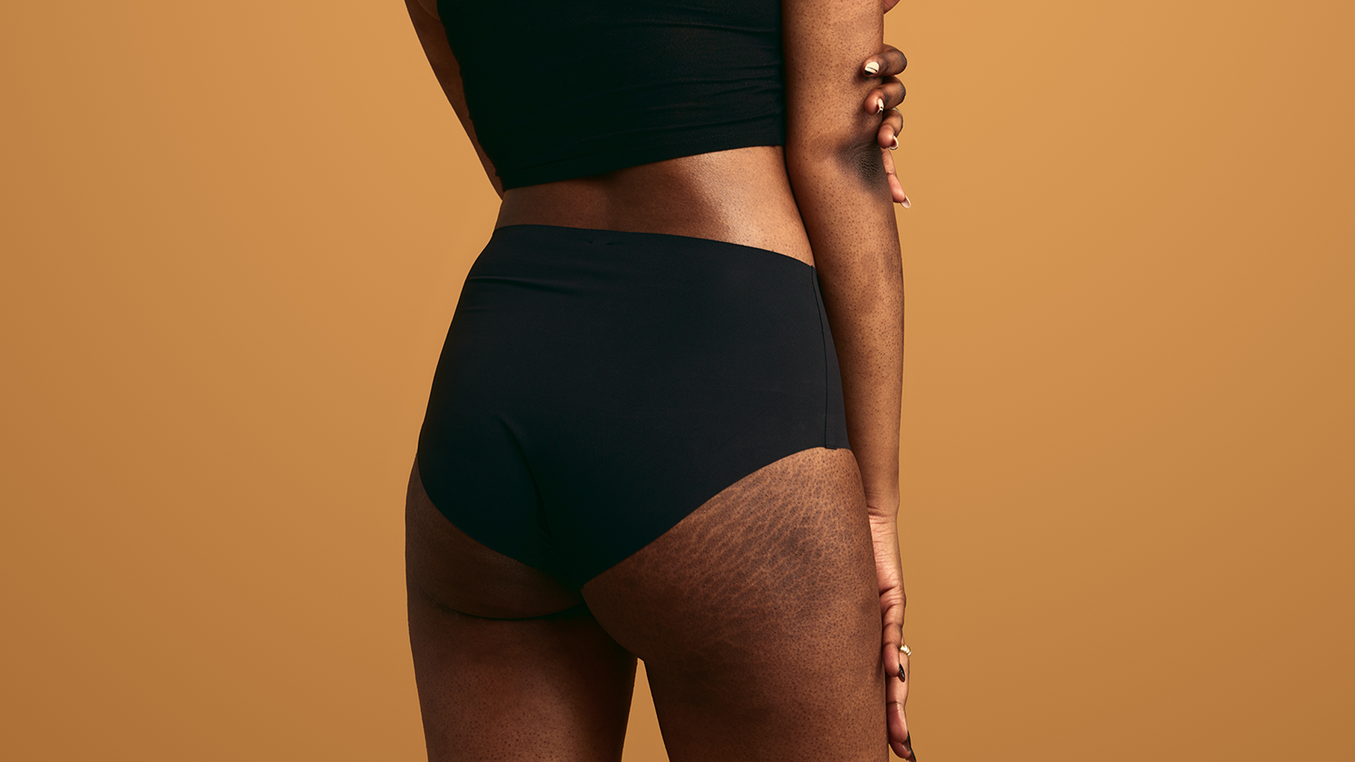 Stretch marks