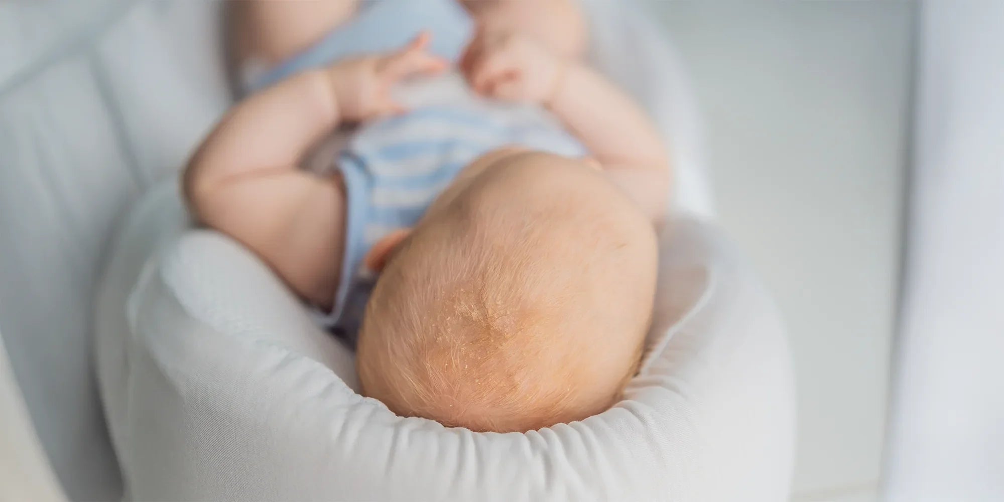 Baby with its head in a cradle cap.