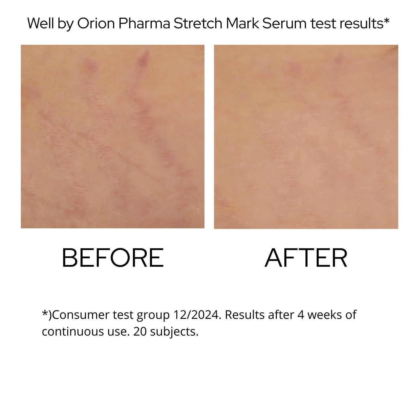 Stretch Mark Serum