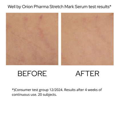 Stretch Mark Serum